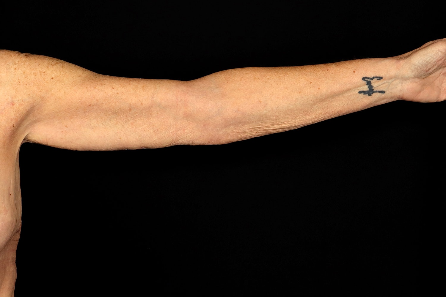 Brachioplasty | Arm Lift Before & After