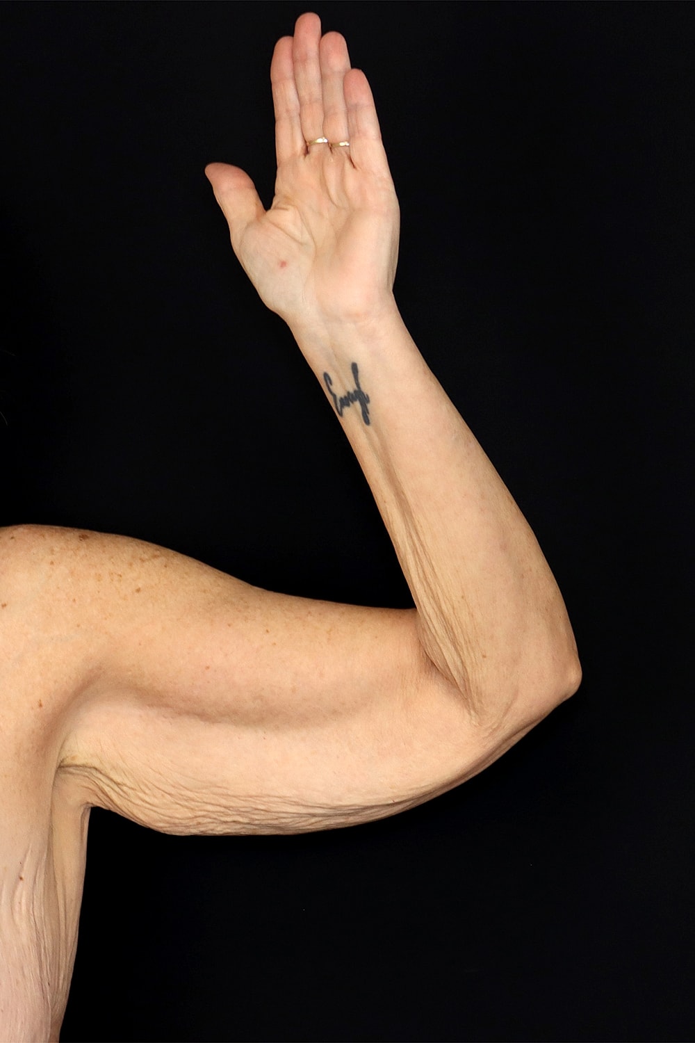 Brachioplasty | Arm Lift Before & After