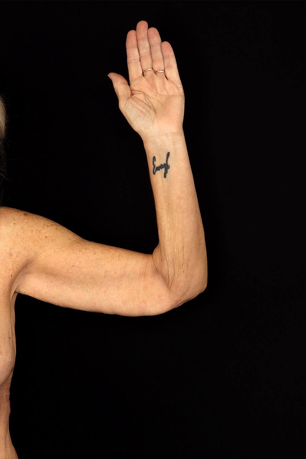 Brachioplasty | Arm Lift Before & After