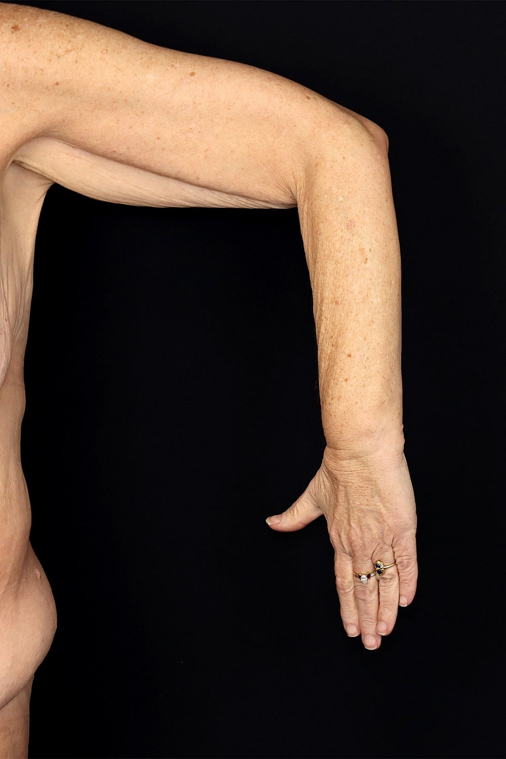 Brachioplasty | Arm Lift Before & After