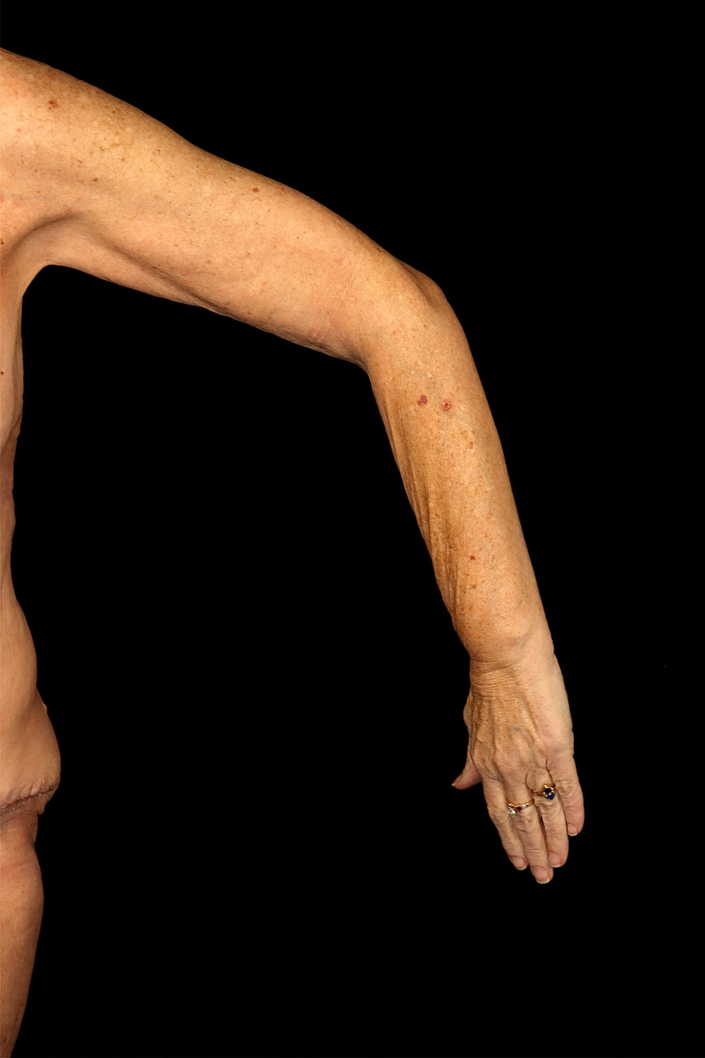 Brachioplasty | Arm Lift Before & After