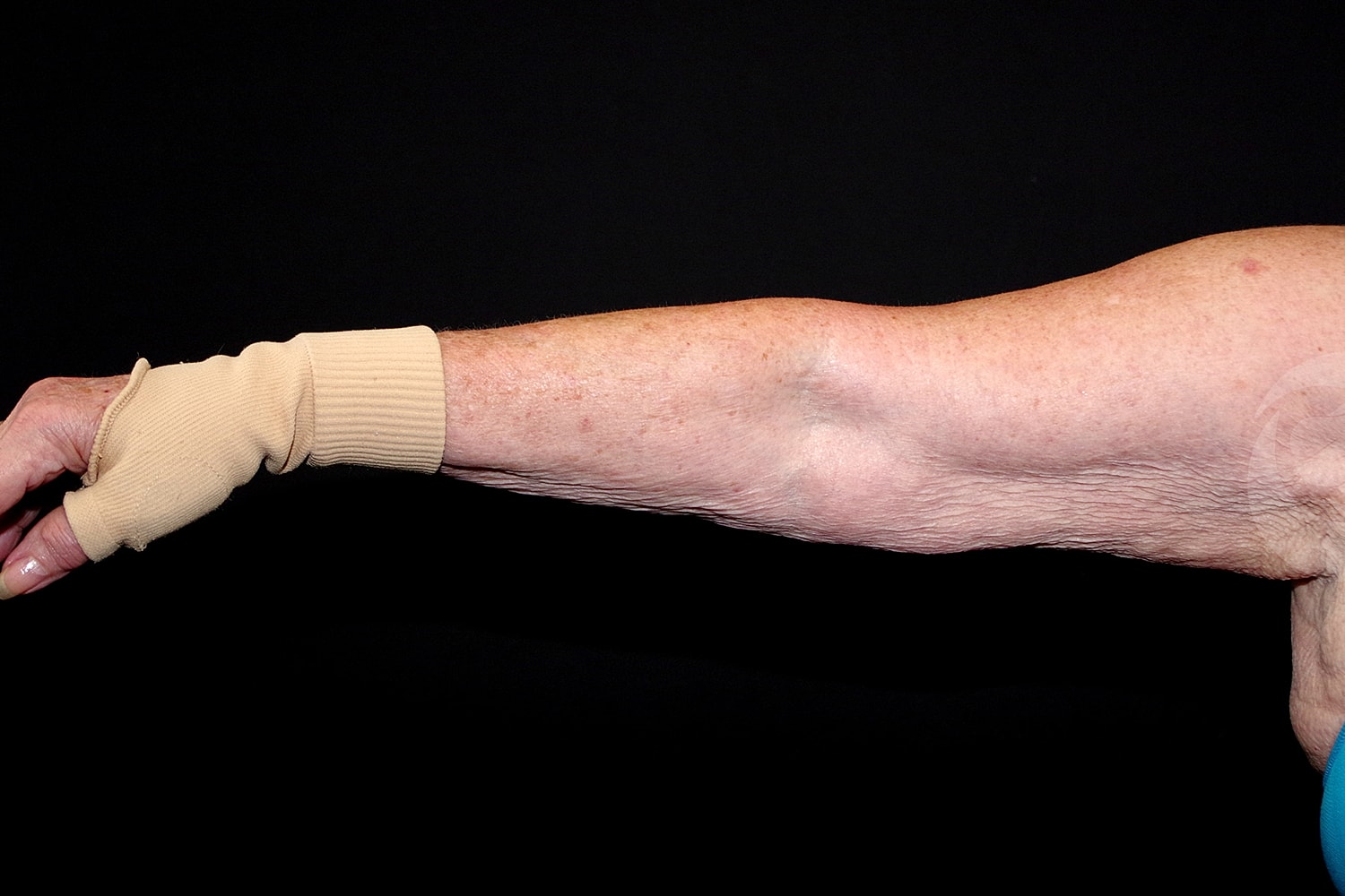 Brachioplasty | Arm Lift Before & After