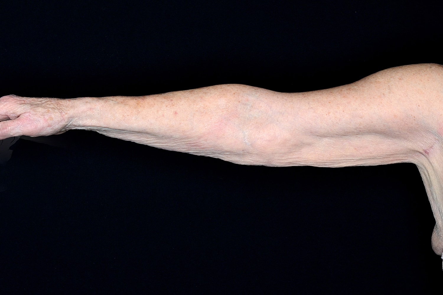 Brachioplasty | Arm Lift Before & After