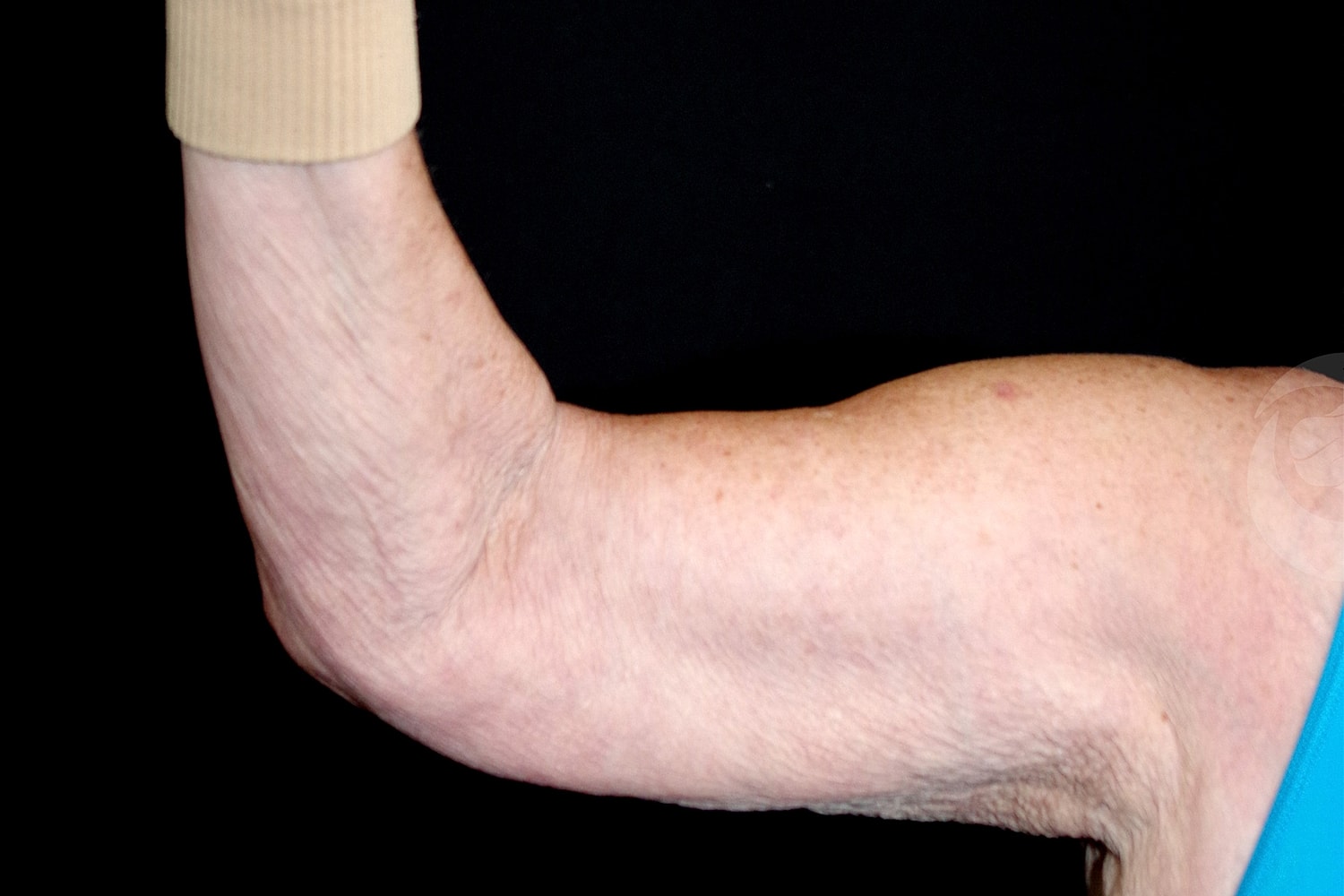 Brachioplasty | Arm Lift Before & After