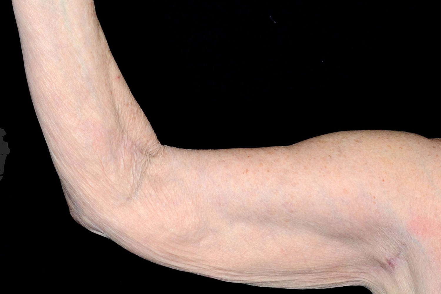 Brachioplasty | Arm Lift Before & After