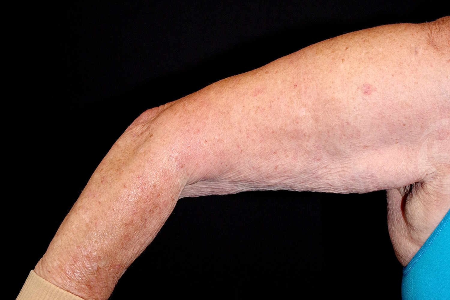Brachioplasty | Arm Lift Before & After