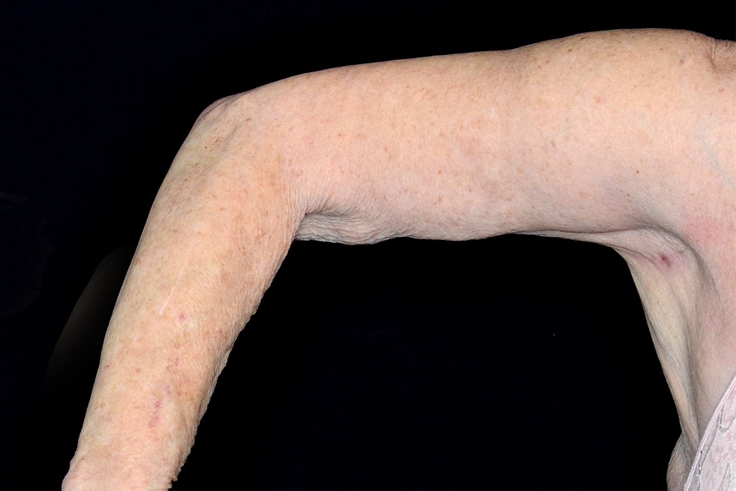 Brachioplasty | Arm Lift Before & After