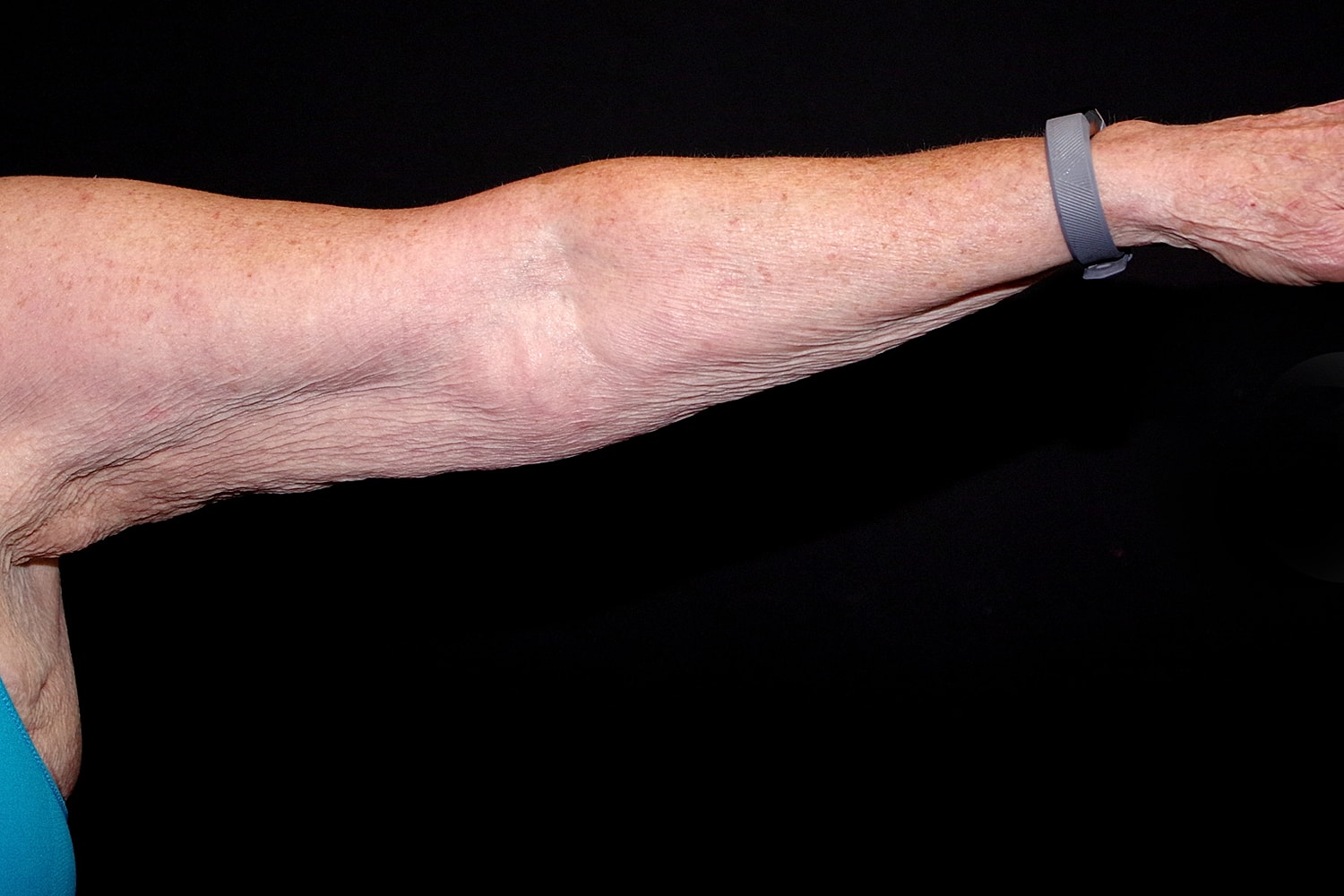 Brachioplasty | Arm Lift Before & After