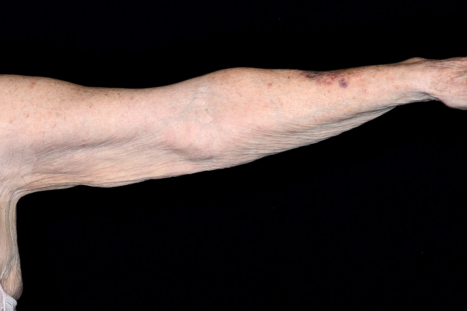 Brachioplasty | Arm Lift Before & After