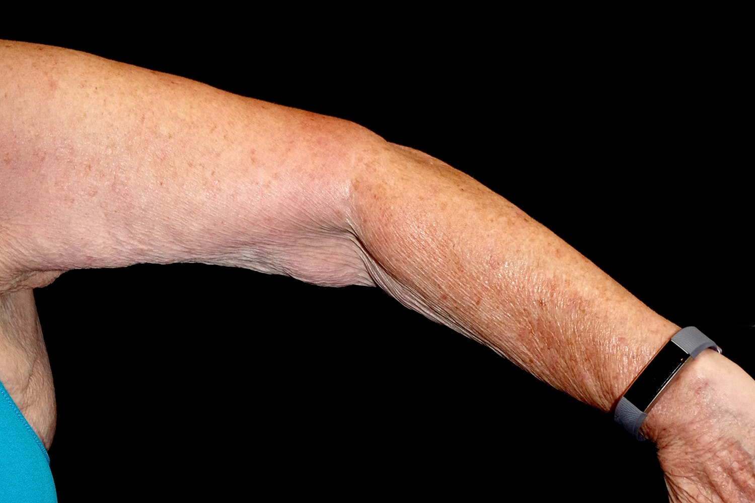 Brachioplasty | Arm Lift Before & After