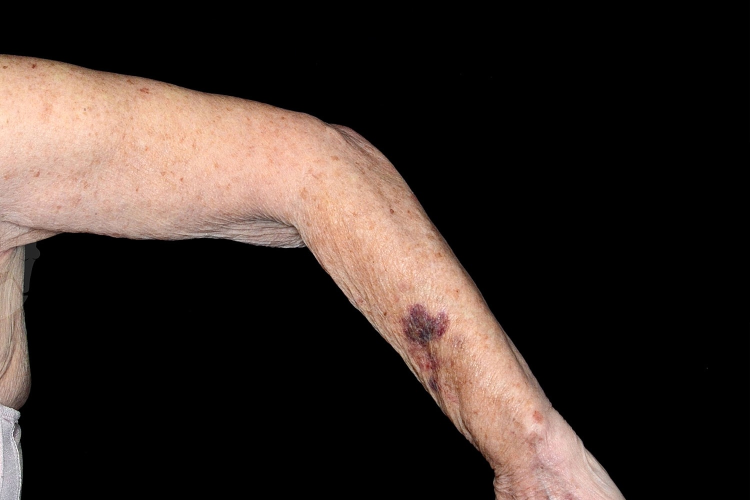 Brachioplasty | Arm Lift Before & After