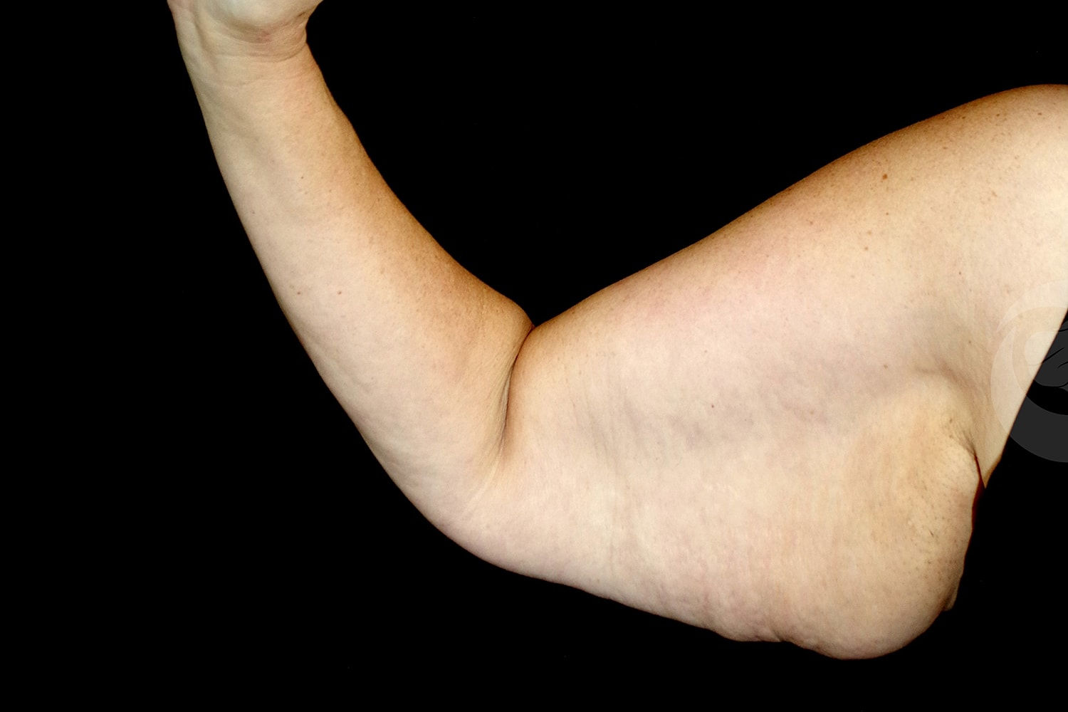 Brachioplasty | Arm Lift Before & After