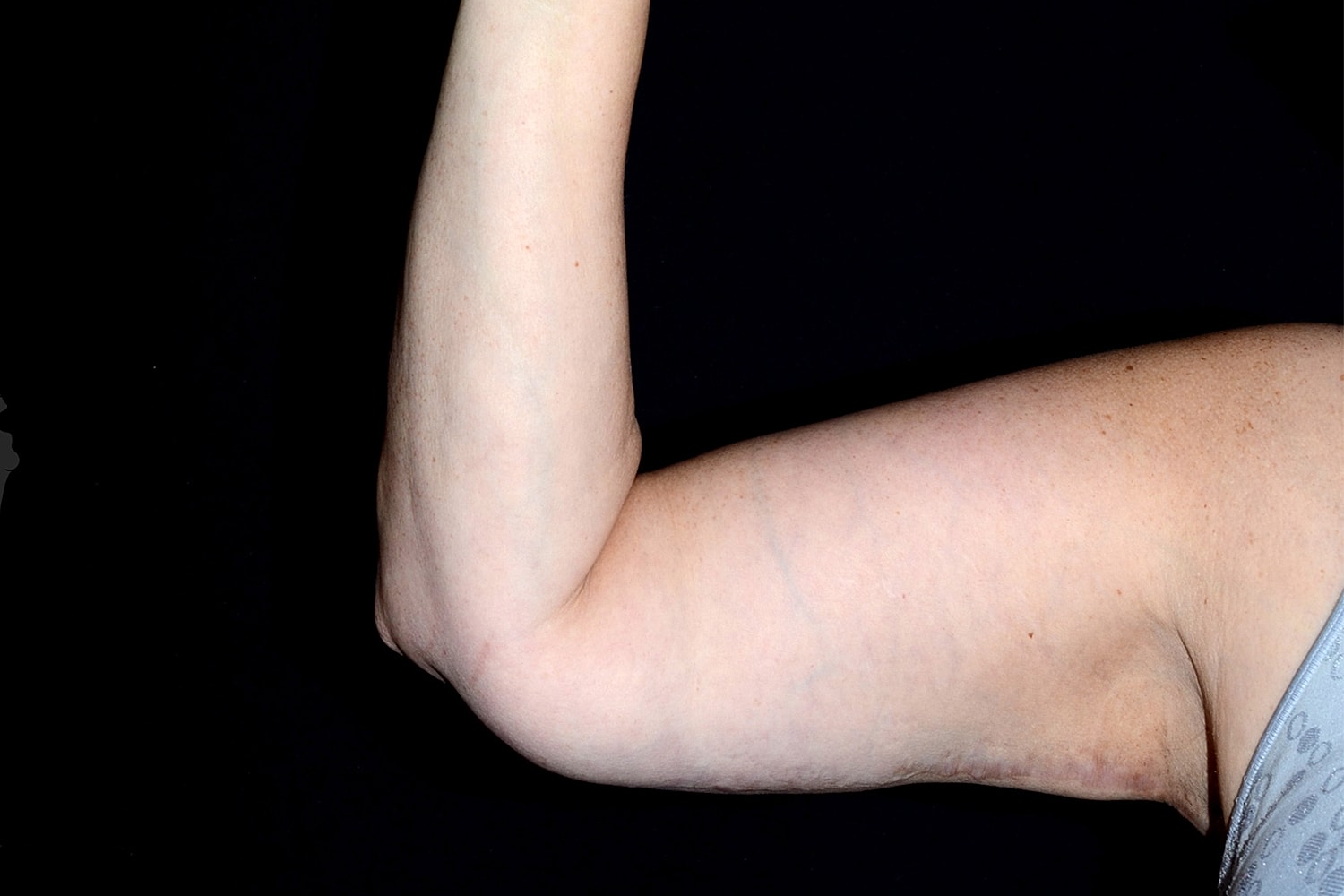 Brachioplasty | Arm Lift Before & After