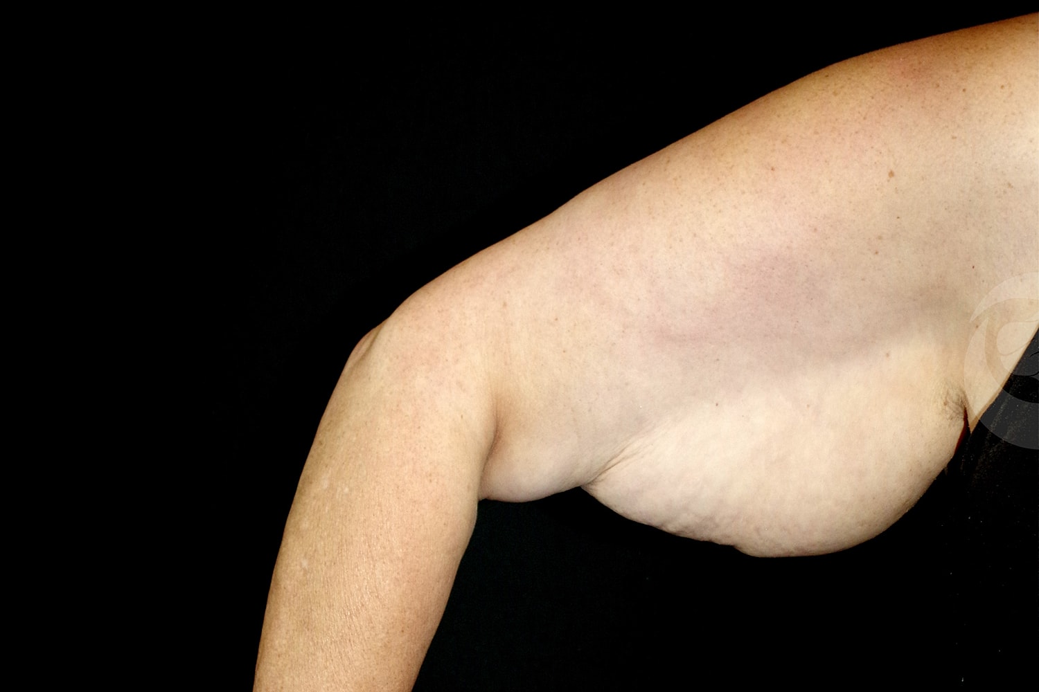Brachioplasty | Arm Lift Before & After