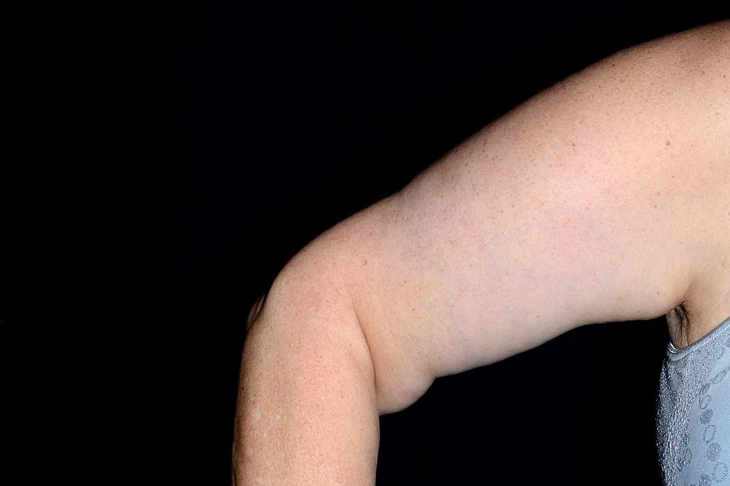 Brachioplasty | Arm Lift Before & After