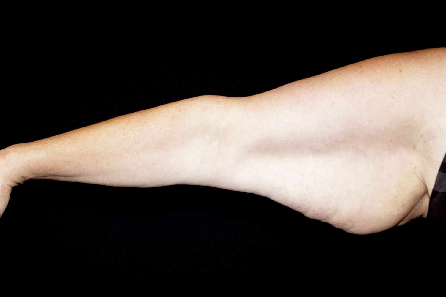 Brachioplasty | Arm Lift Before & After