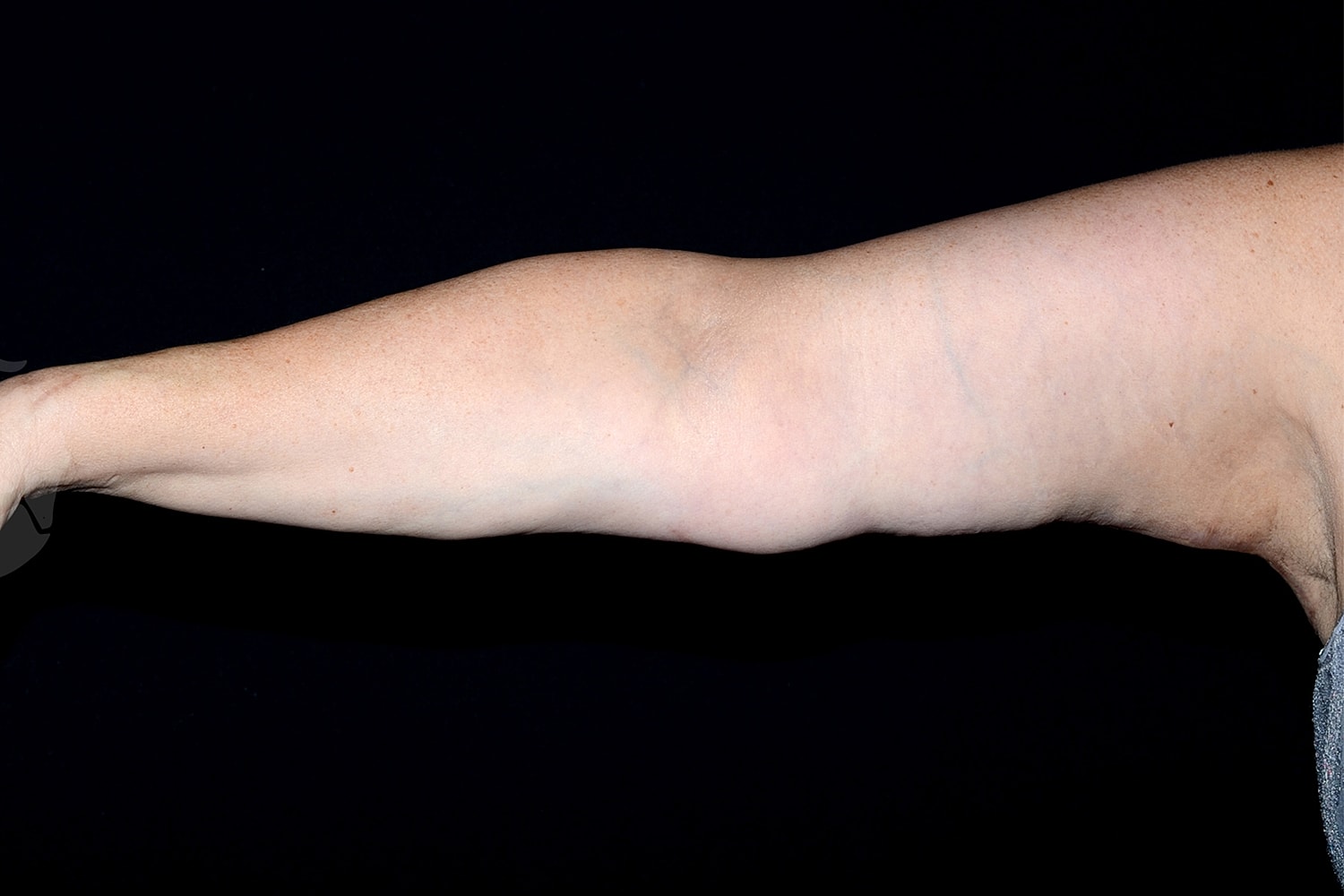 Brachioplasty | Arm Lift Before & After