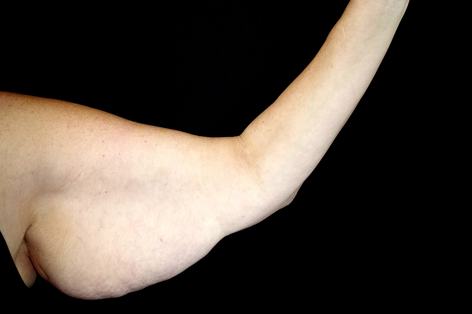 Brachioplasty | Arm Lift Before & After