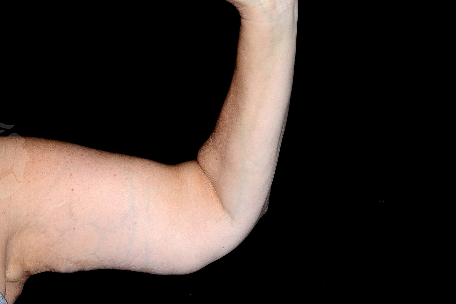 Brachioplasty | Arm Lift Before & After