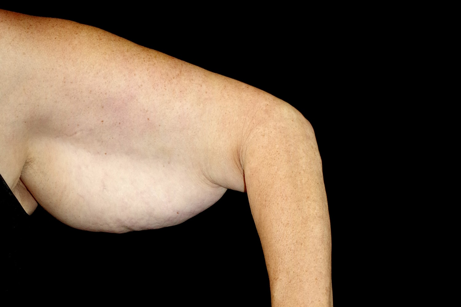 Brachioplasty | Arm Lift Before & After