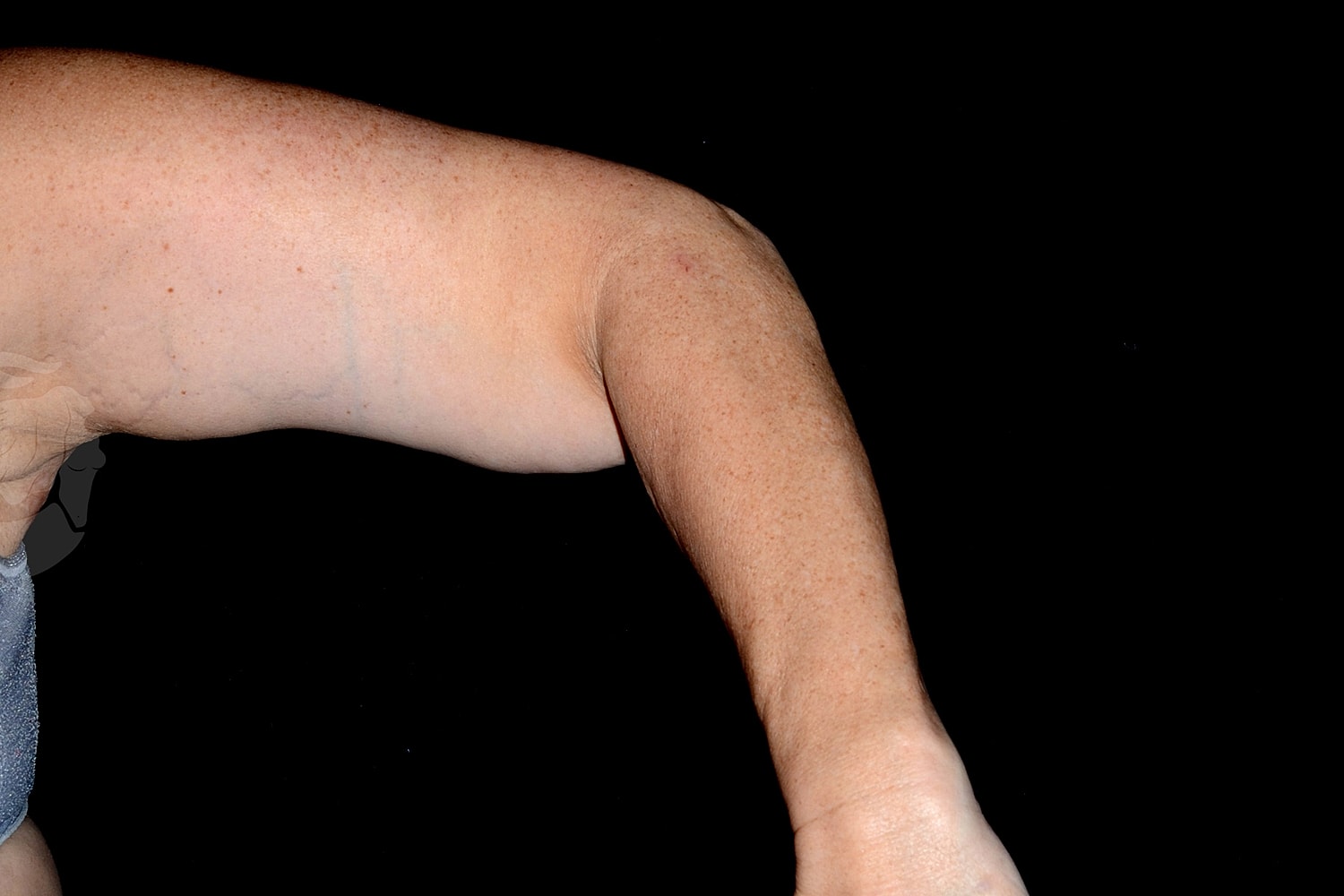 Brachioplasty | Arm Lift Before & After