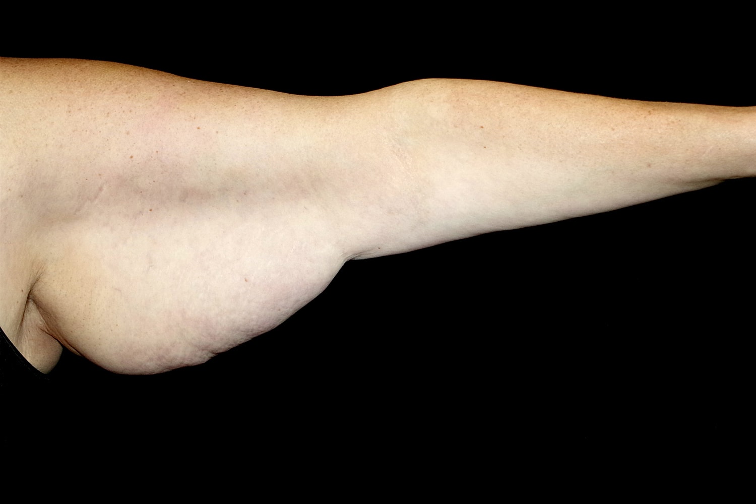 Brachioplasty | Arm Lift Before & After
