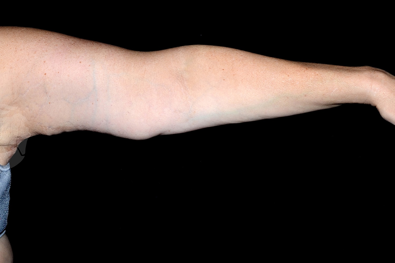 Brachioplasty | Arm Lift Before & After