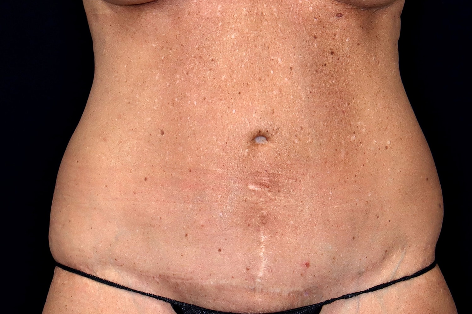 Tummy Tuck Before & After