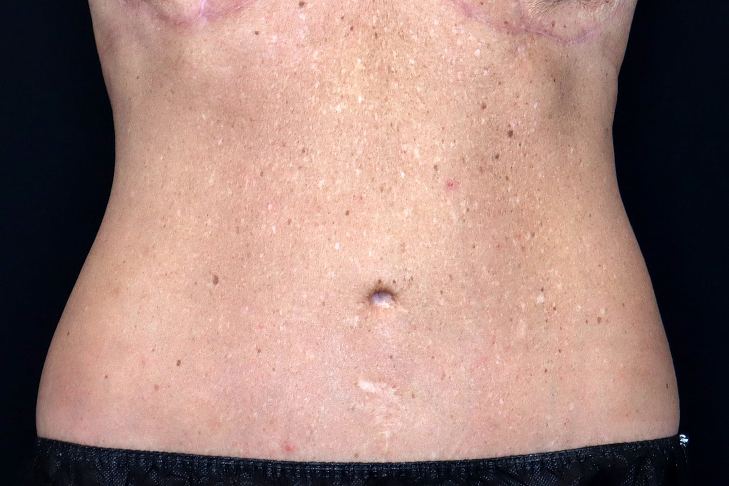 Tummy Tuck Before & After
