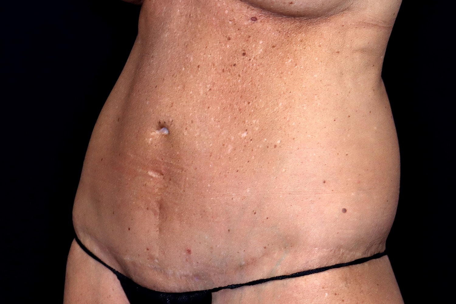 Tummy Tuck Before & After