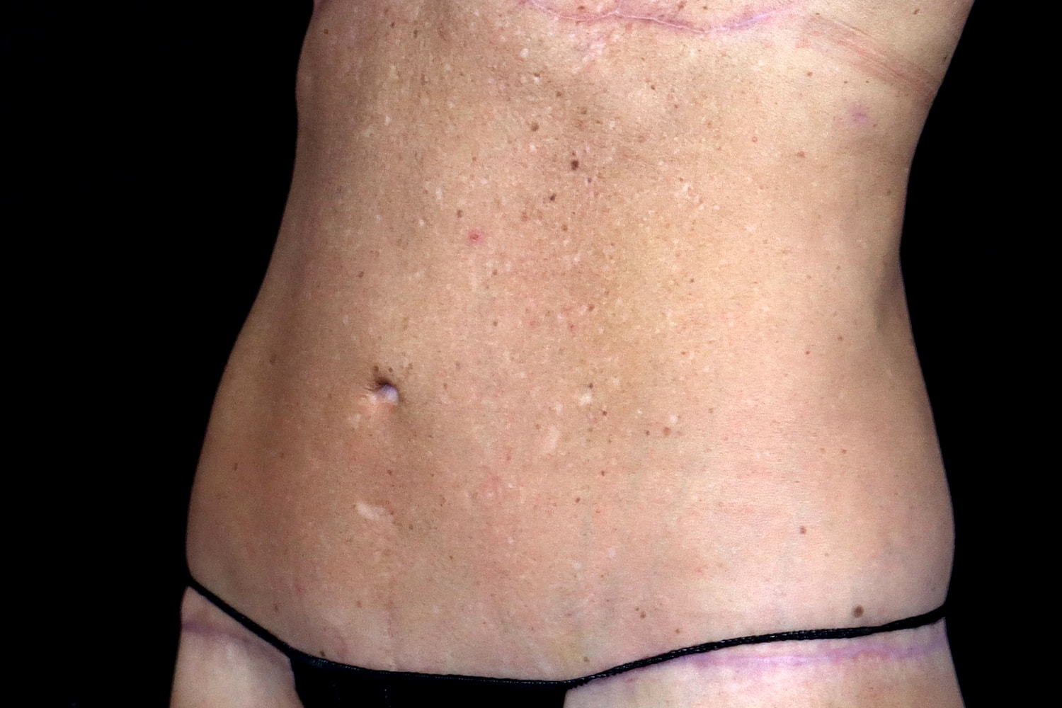 Tummy Tuck Before & After