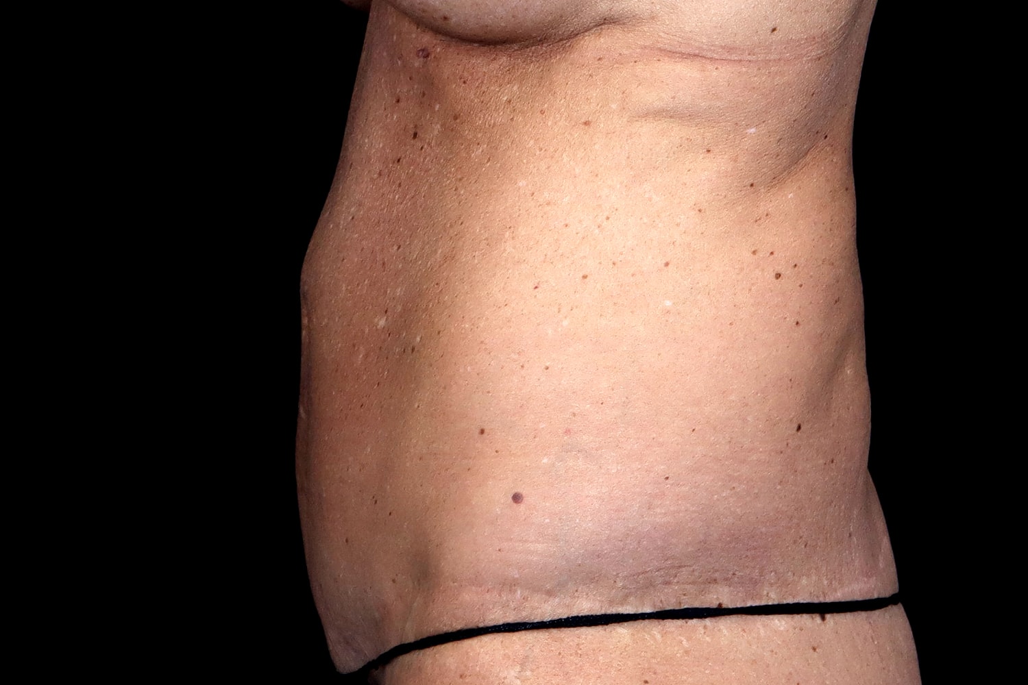 Tummy Tuck Before & After