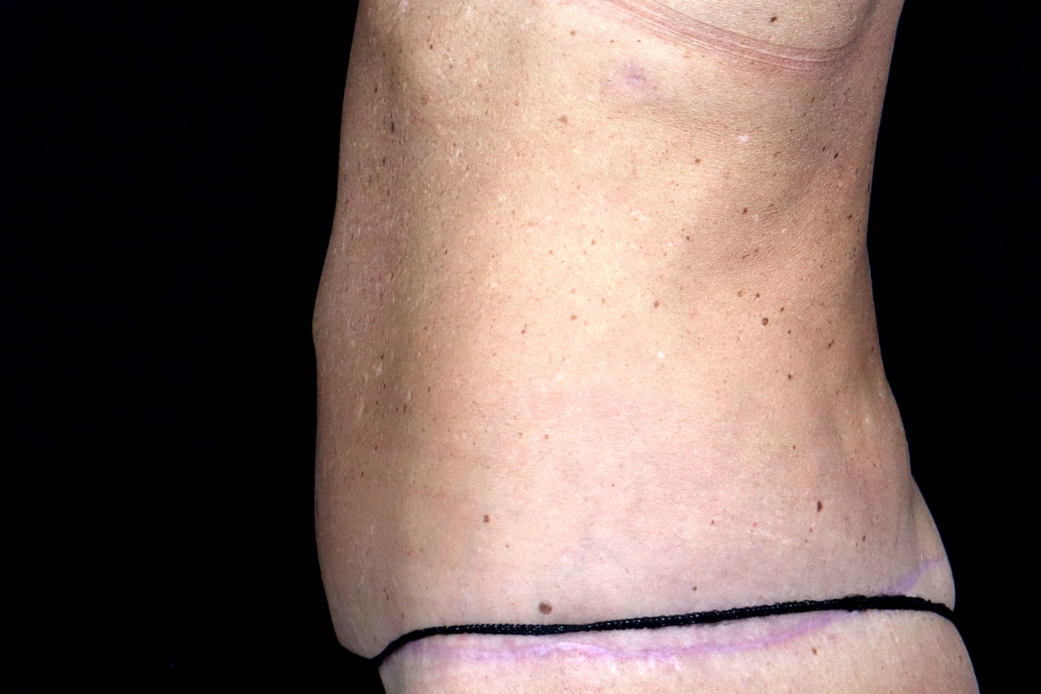 Tummy Tuck Before & After