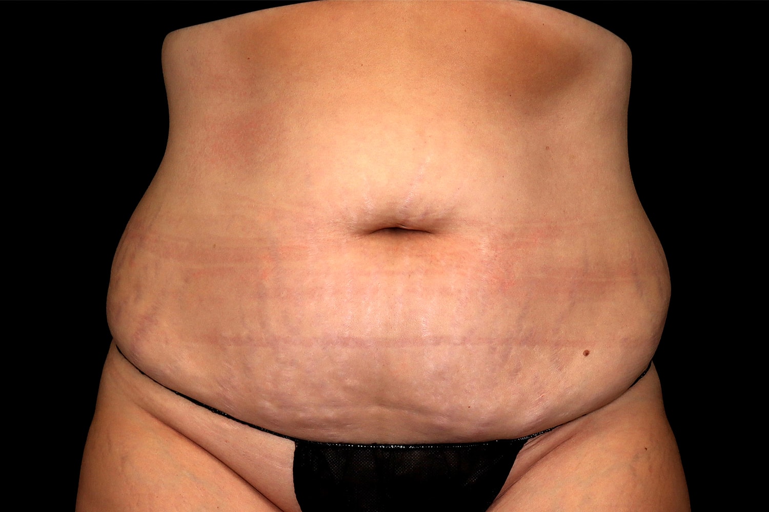 Tummy Tuck Before & After