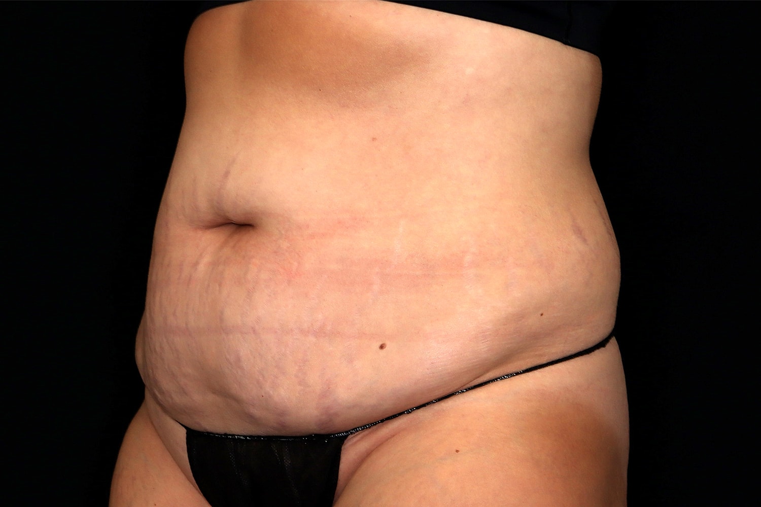 Tummy Tuck Before & After