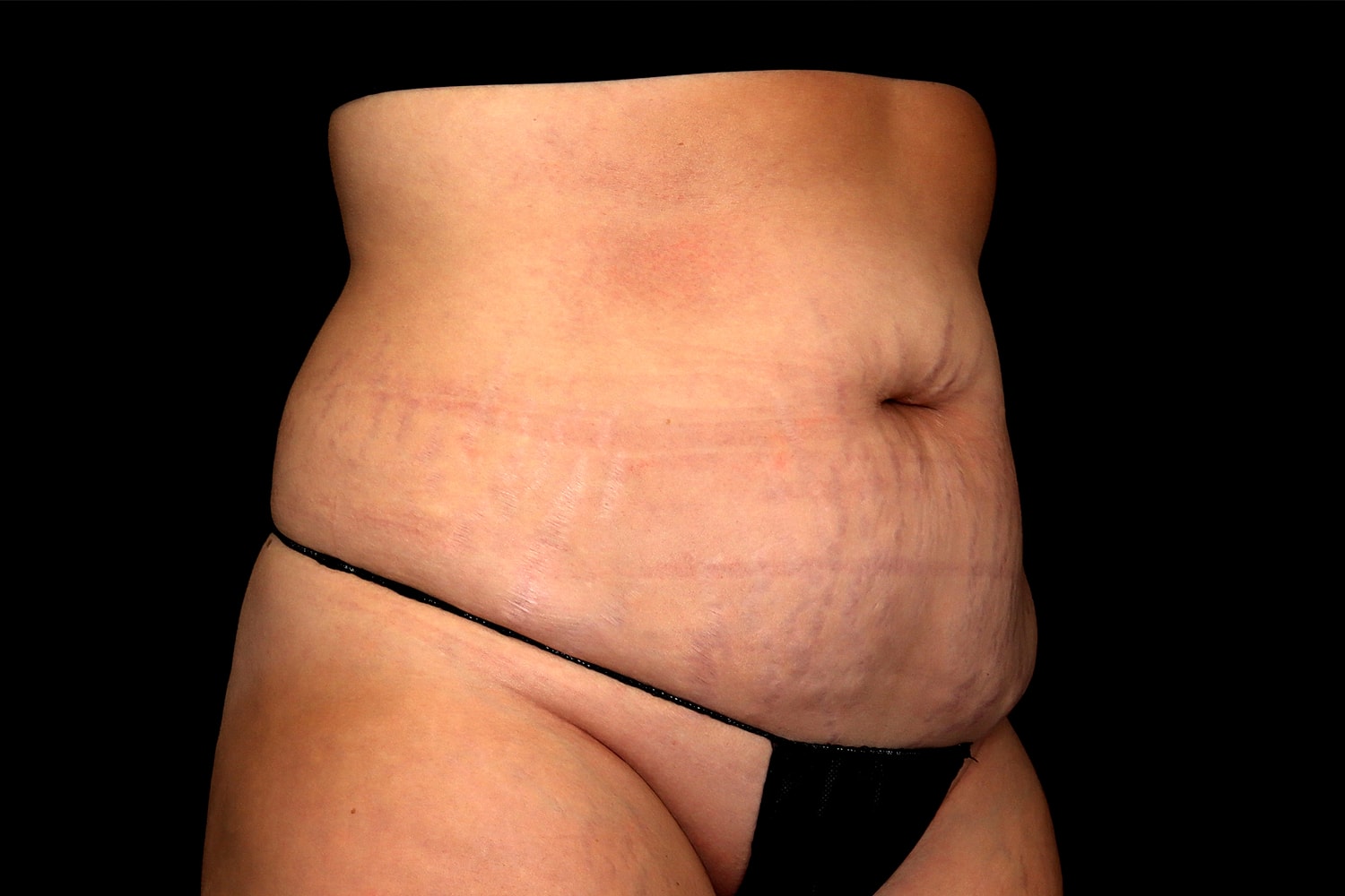 Tummy Tuck Before & After
