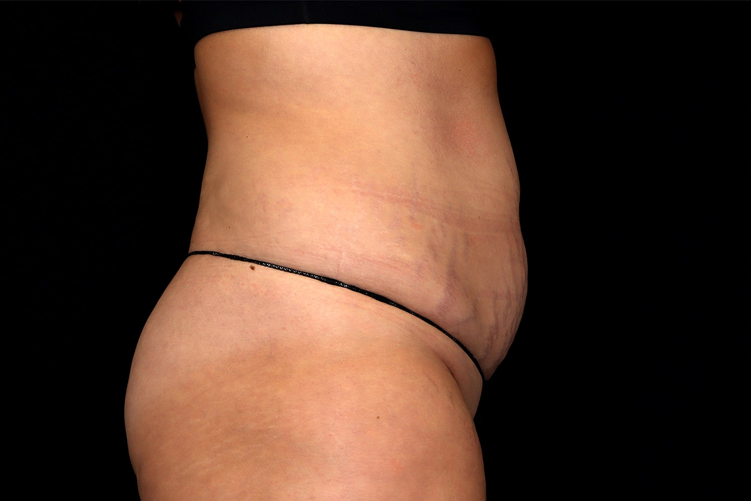 Tummy Tuck Before & After