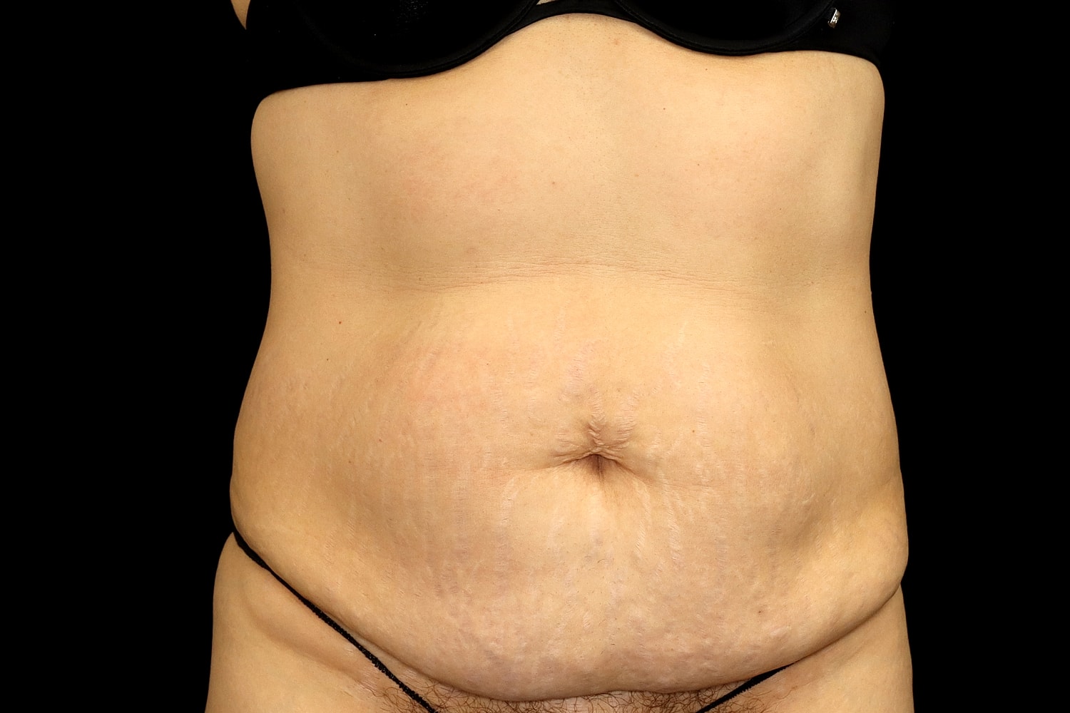 Tummy Tuck Before & After
