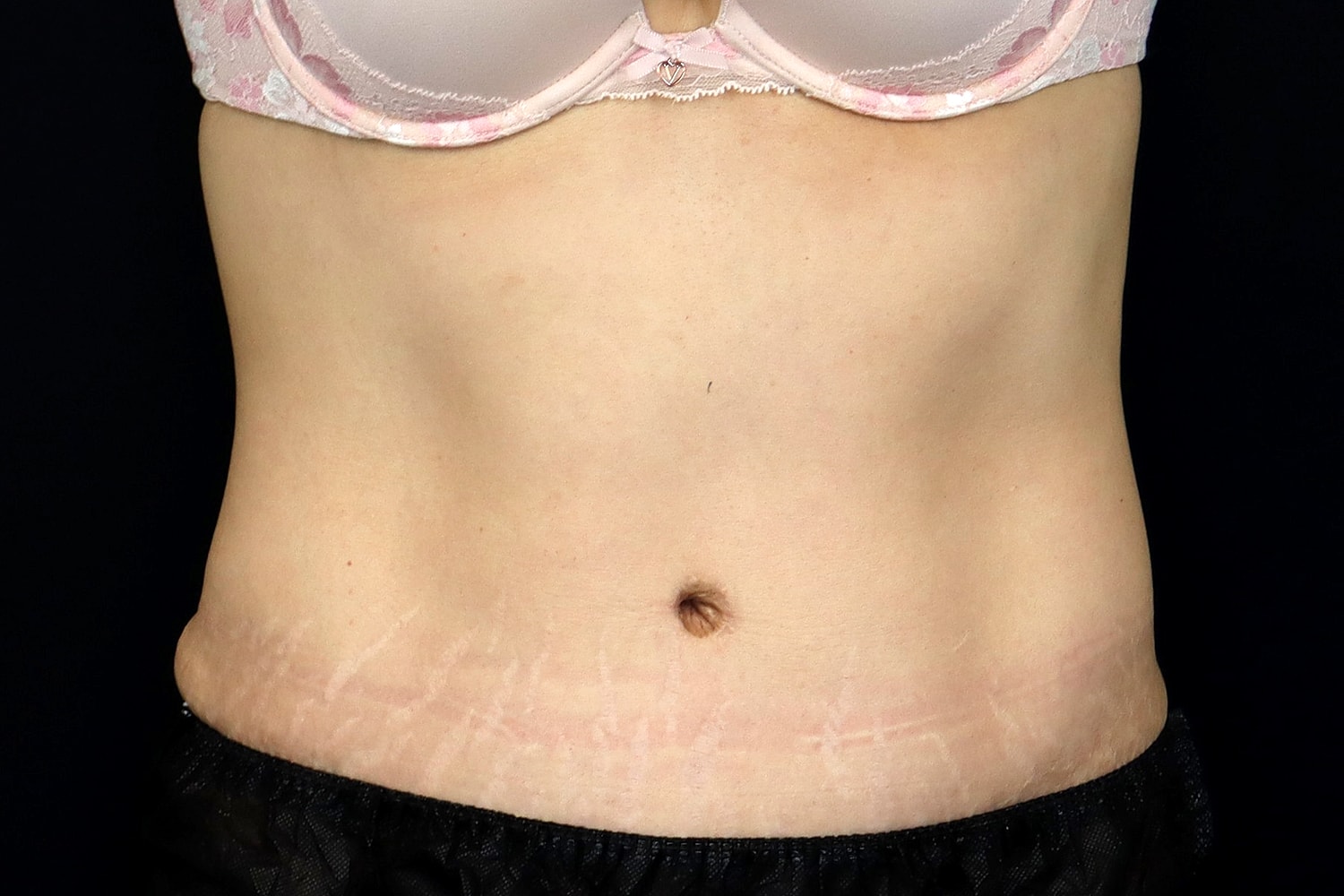 Tummy Tuck Before & After