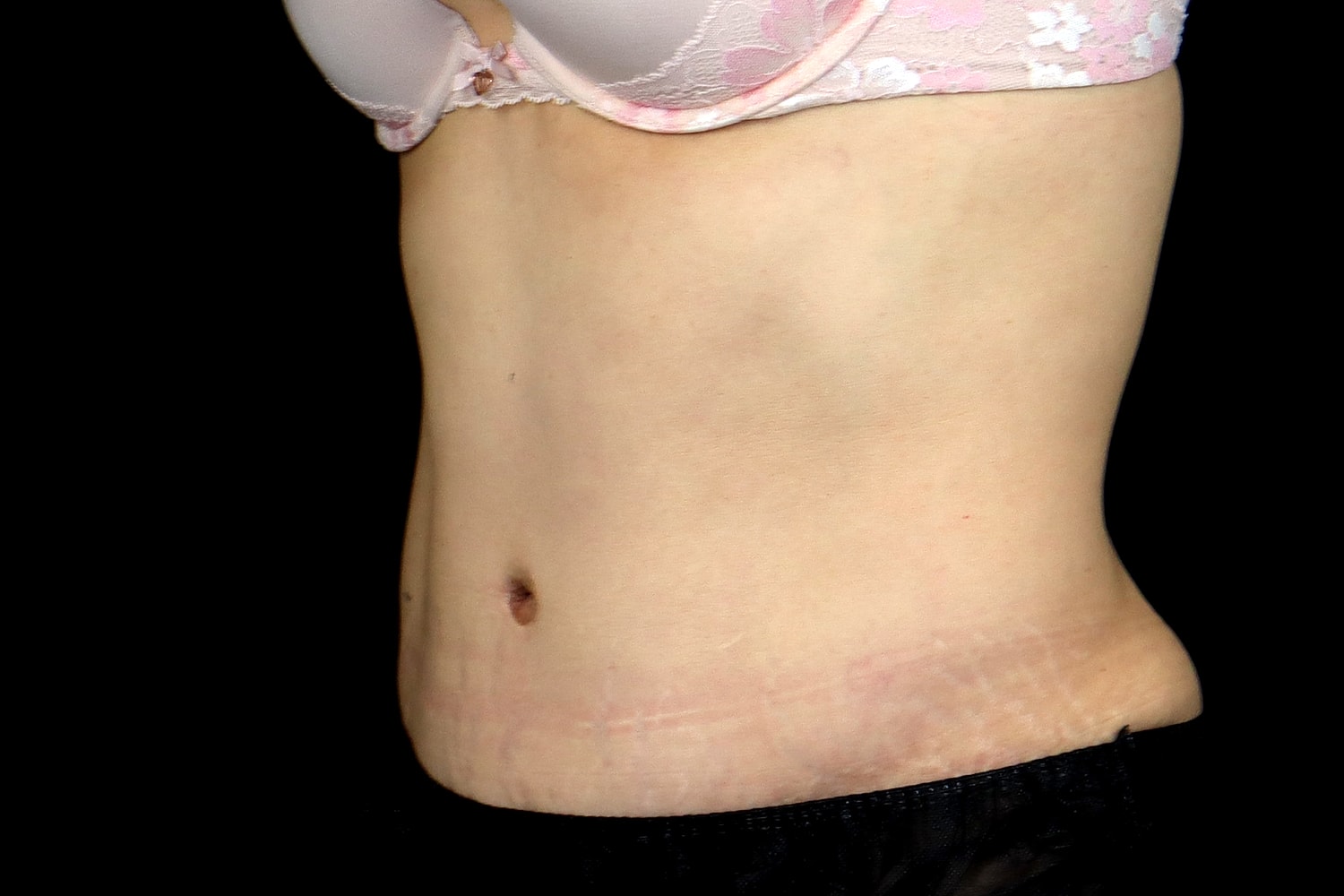 Tummy Tuck Before & After