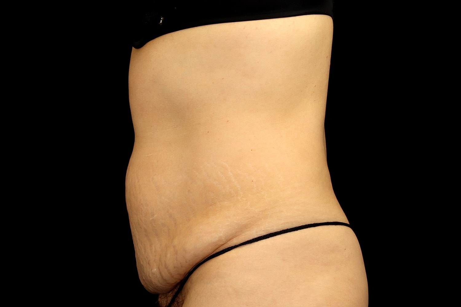 Tummy Tuck Before & After