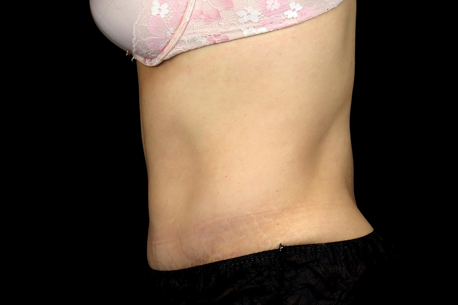 Tummy Tuck Before & After