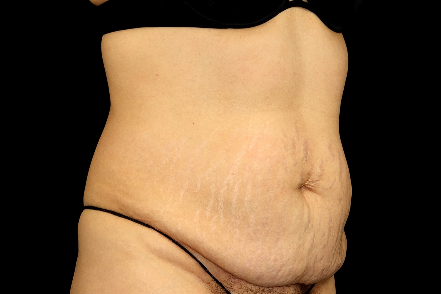 Tummy Tuck Before & After