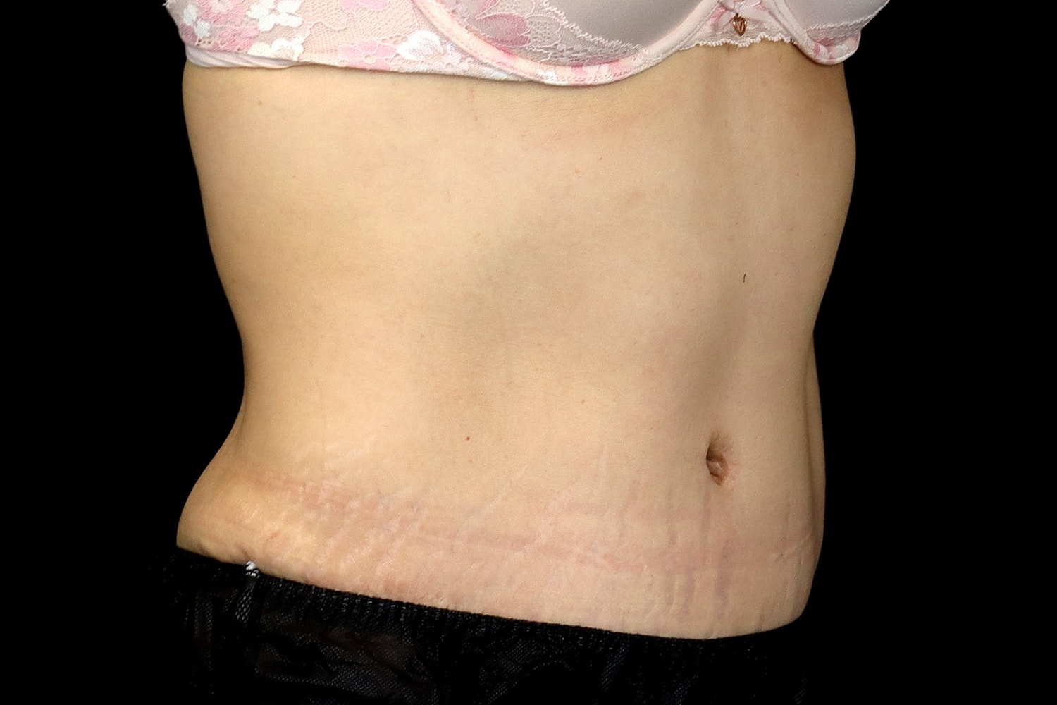 Tummy Tuck Before & After