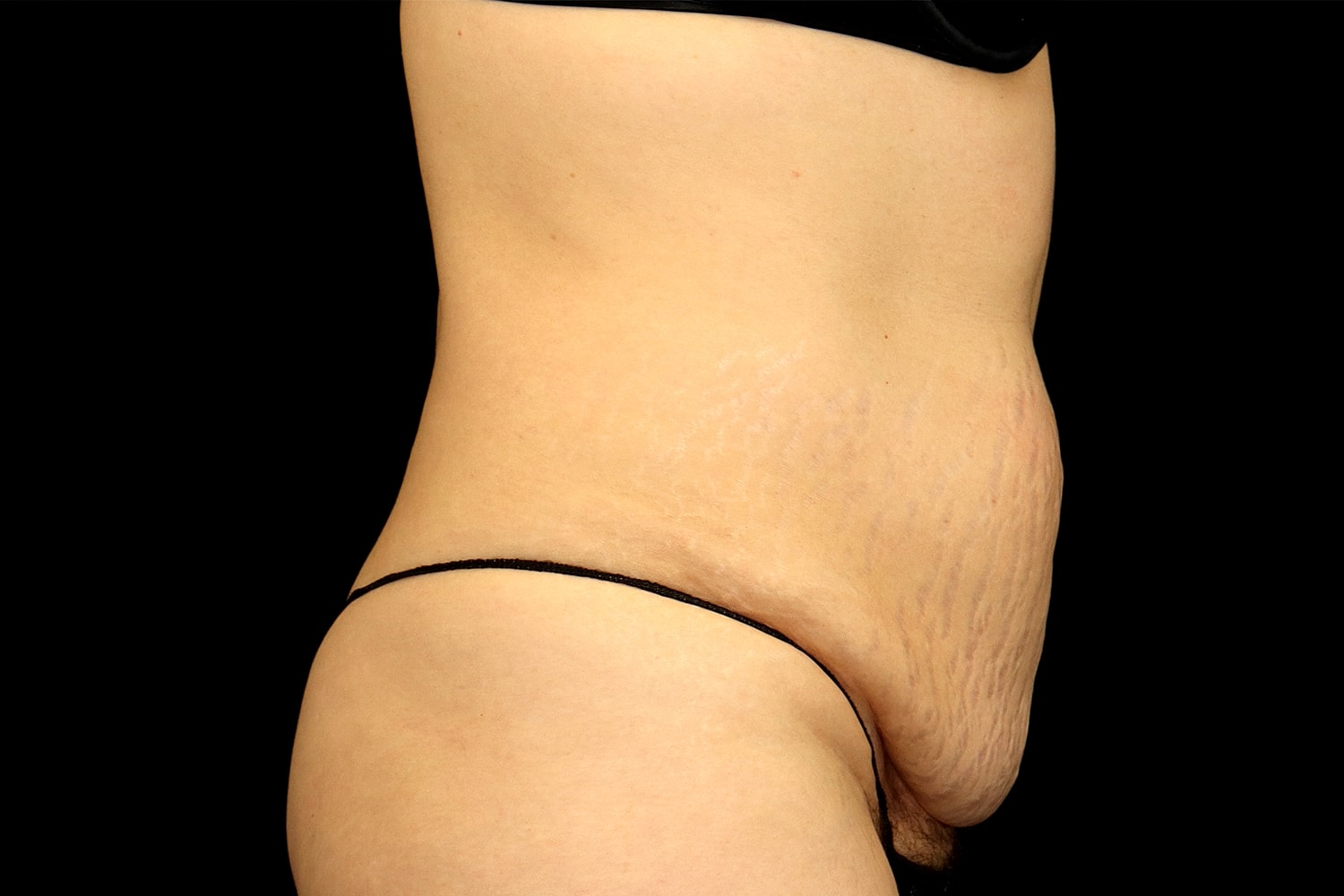 Tummy Tuck Before & After
