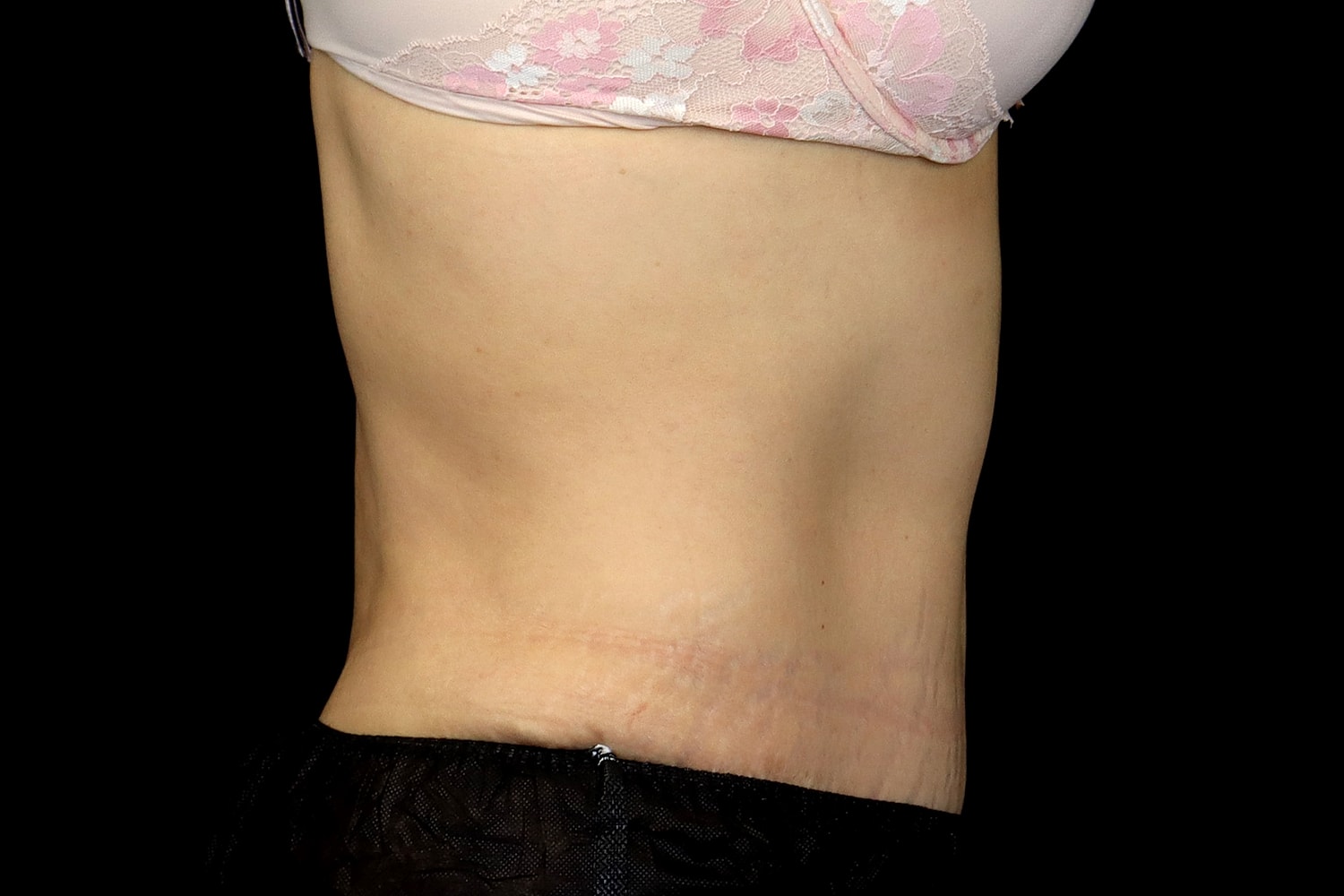 Tummy Tuck Before & After
