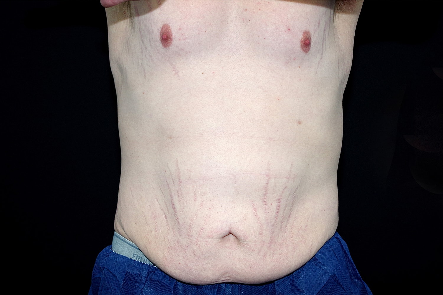 Tummy Tuck Before & After