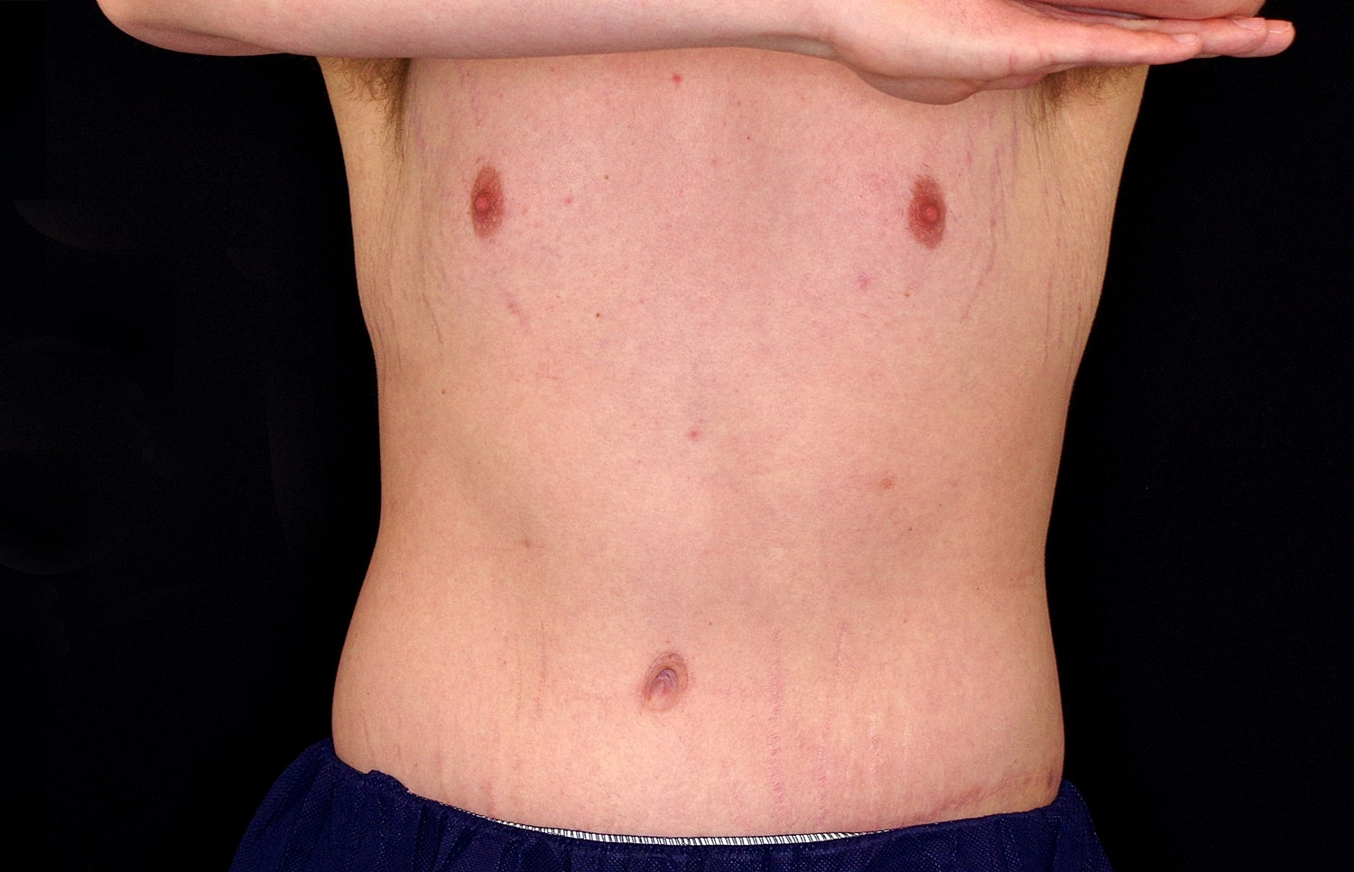 Tummy Tuck Before & After