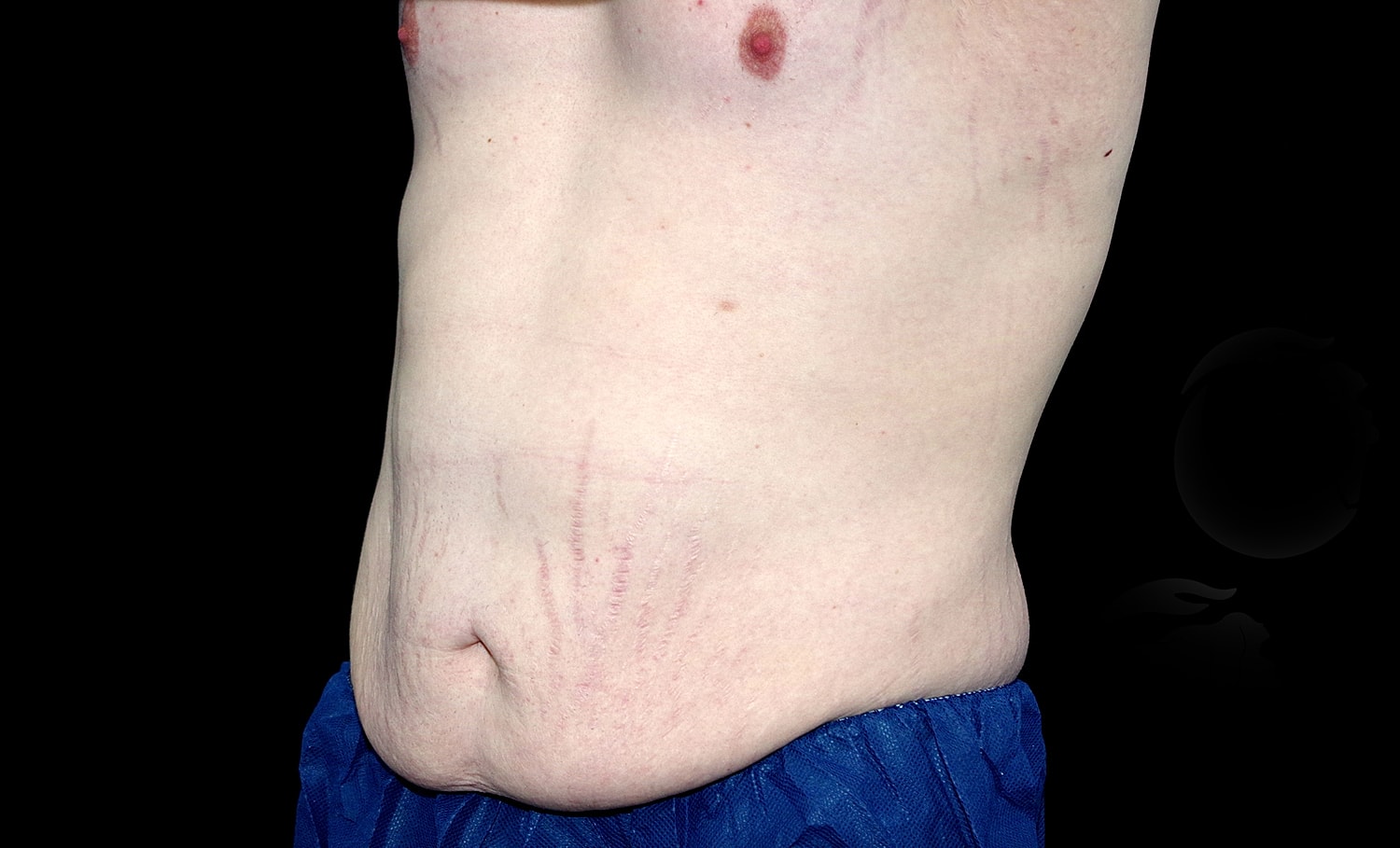 Tummy Tuck Before & After