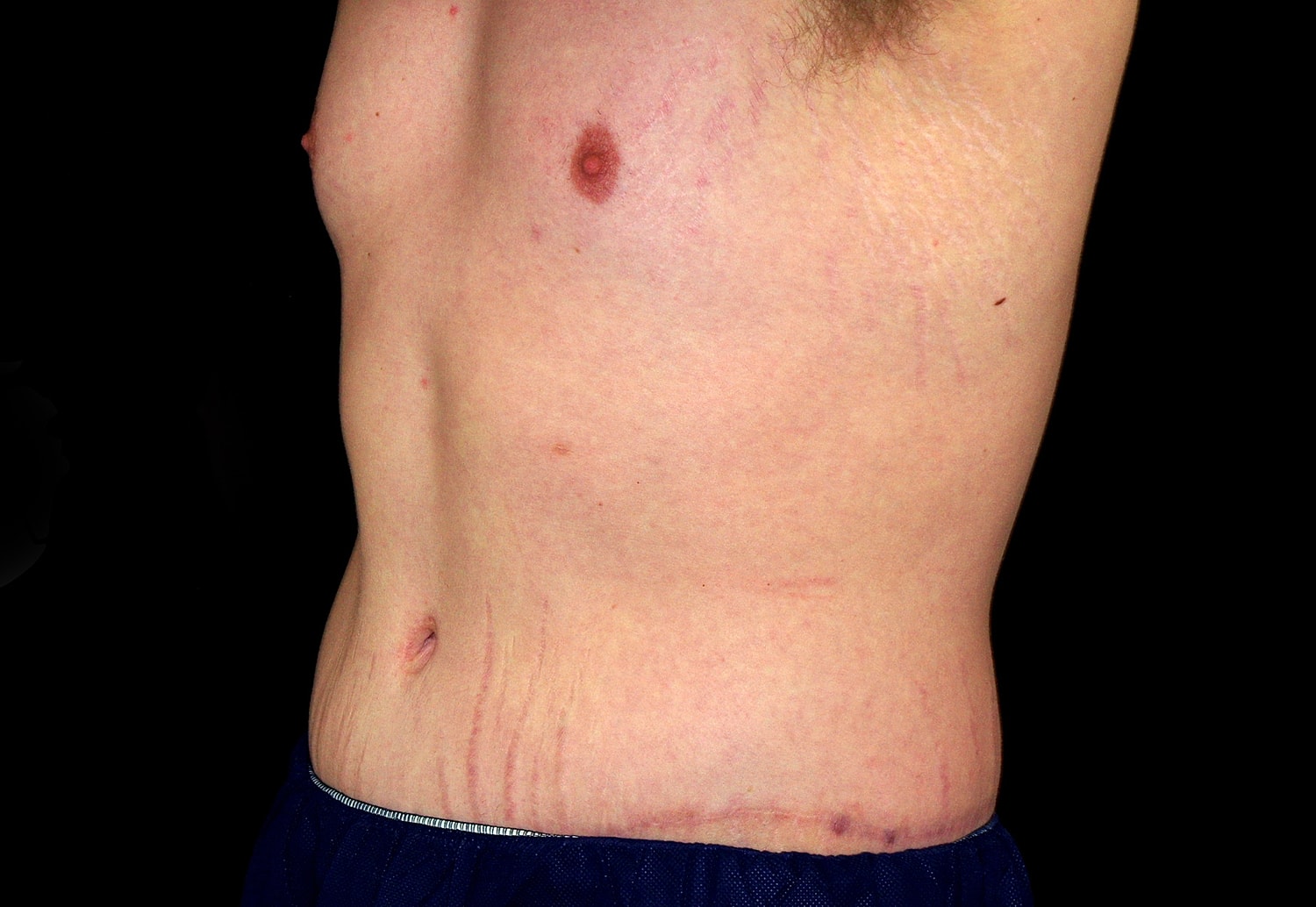 Tummy Tuck Before & After